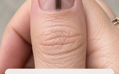 Je viens de remarquer une rayure verticale foncée sur l'ongle du pouce de mon père. Il n'y prête pas attention, mais je crains que ce soit grave, et nous ne pouvons pas consulter un spécialiste pour le moment.
