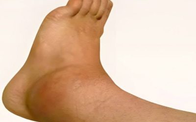 Chevilles et pieds enflés : les causes révélées !