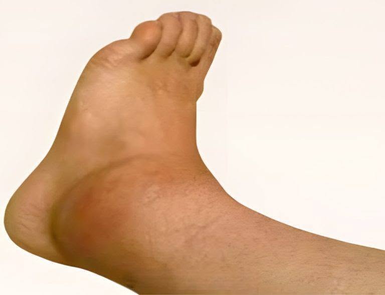 Chevilles et pieds enflés : les causes révélées !