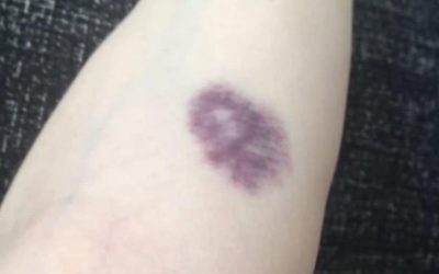 ATTENTION, si vous avez ces ecchymoses sur le corps, cela signifie que vous avez un cancer… voir plus