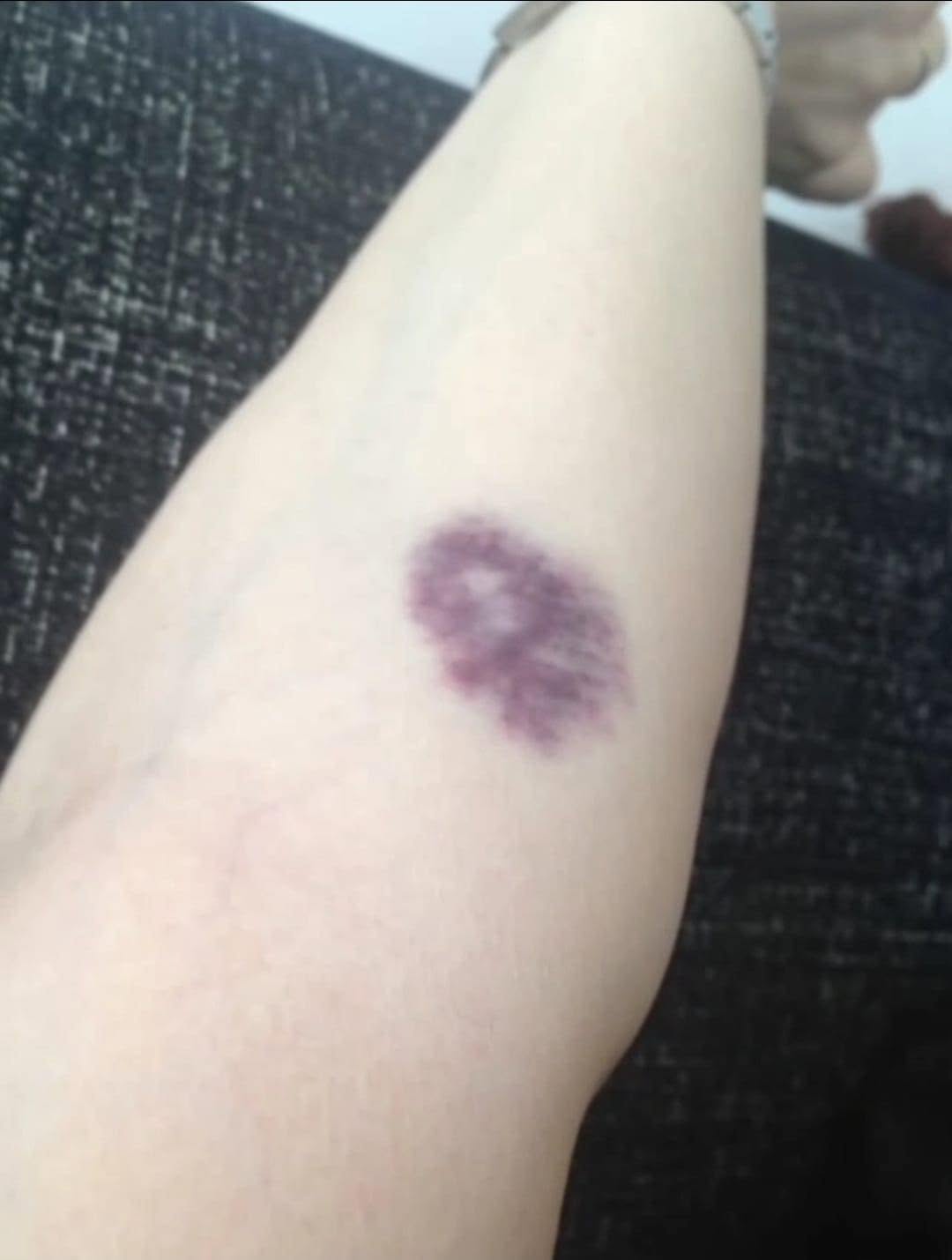 ATTENTION, si vous avez ces ecchymoses sur le corps, cela signifie que vous avez un cancer… voir plus