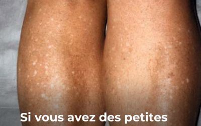 Si vous avez des petites taches blanches sur vos bras ou vos jambes, c’est un signe claire que…Voir plus