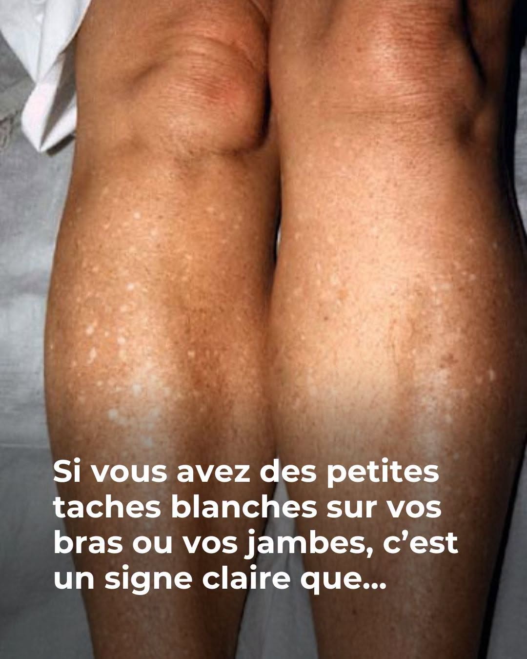 Si vous avez des petites taches blanches sur vos bras ou vos jambes, c’est un signe claire que…Voir plus