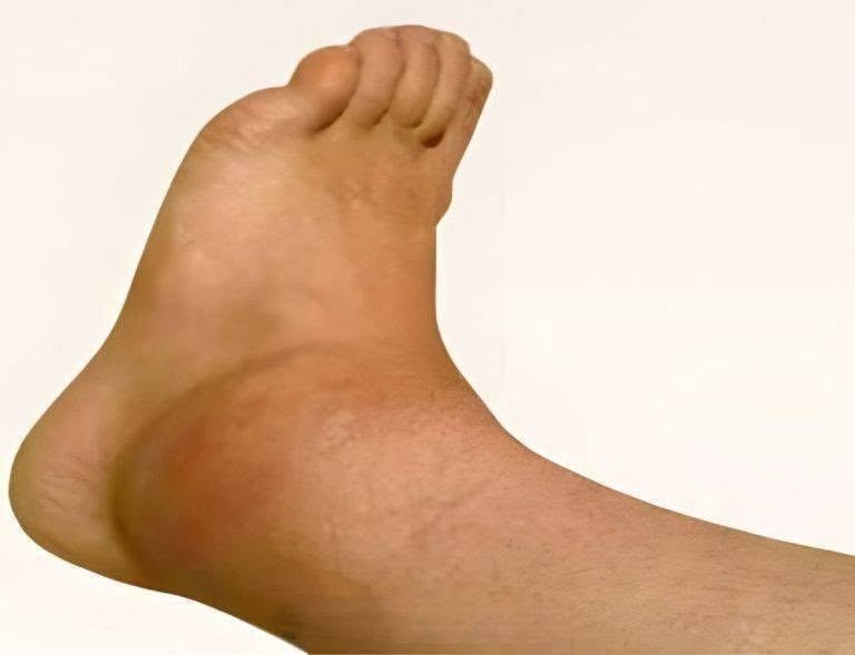 Explication des chevilles et des pieds enflés : les causes révélées !