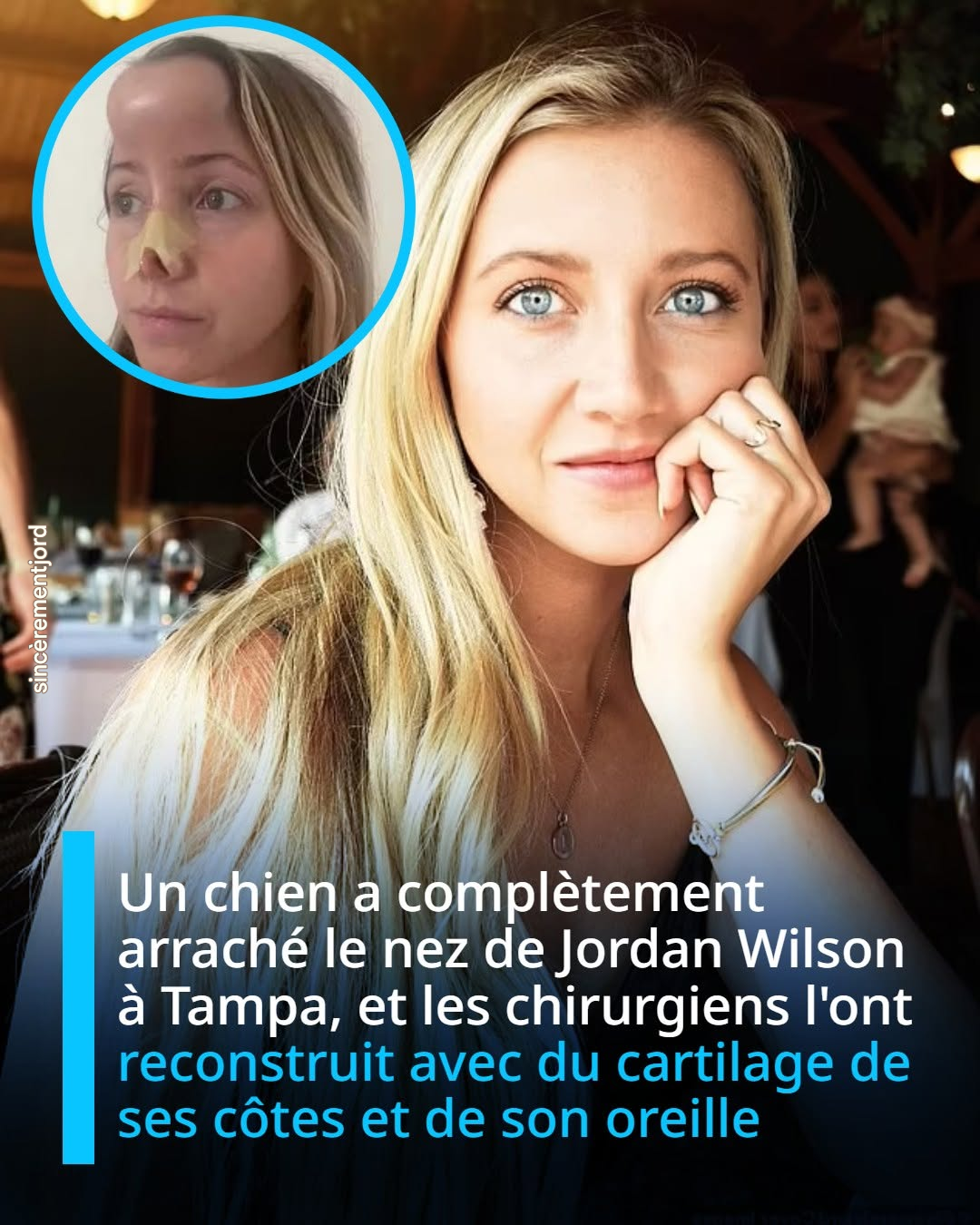 Un chien a complètement arraché le nez de Jordan Wilson à Tampa, et des chirurgiens l’ont reconstruit avec du cartilage de ses côtes et de son oreille
