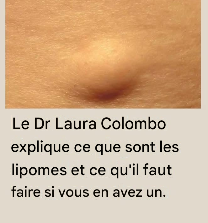 Le Dr Laura Colombo explique ce que sont les lipomes et ce qu'il faut faire si vous en avez un (1 / 2)