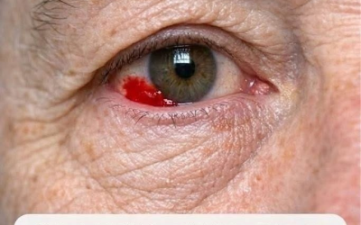 Mon mari de 64 ans s'est réveillé avec une tache rouge et saignante sur l'œil. Devrions-nous aller à l'hôpital ?